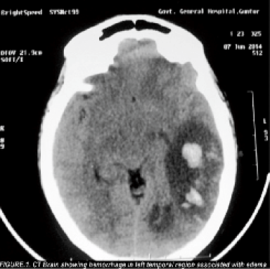 CT Brain showing hemorrhage in left temporal region associated with edema.