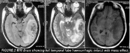MRI Brain showing haemorrhagic infarct with mass effect in the left temporal lobe.