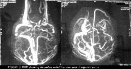 MRV showing thrombus in the left transverse and sigmoid sinus.