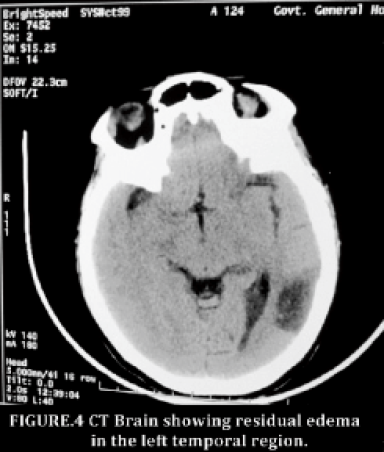 CT Brain showing residual edema in the left temporal region.
