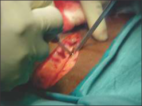 Showing the midline posterior exposure to the lumbar spine.