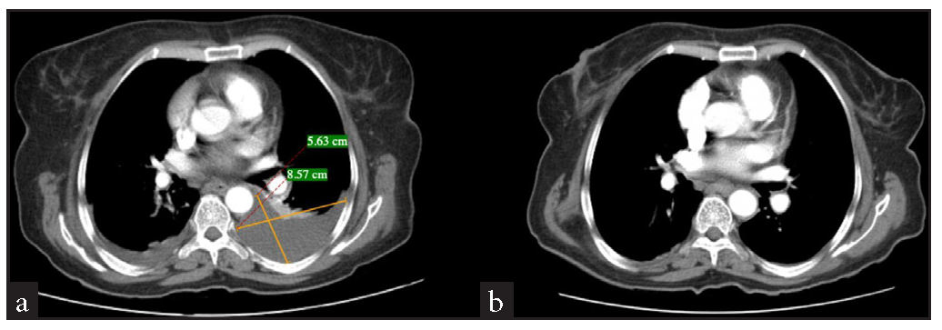 Contrast CT abdomen and pelvis. (a) Contrast CT abdomen reveals a psoas collection (8.57cm *5.63 cm) communicating with the left paracolic gutter. (b) Contrast CT abdomen after the aspiration of the collection.