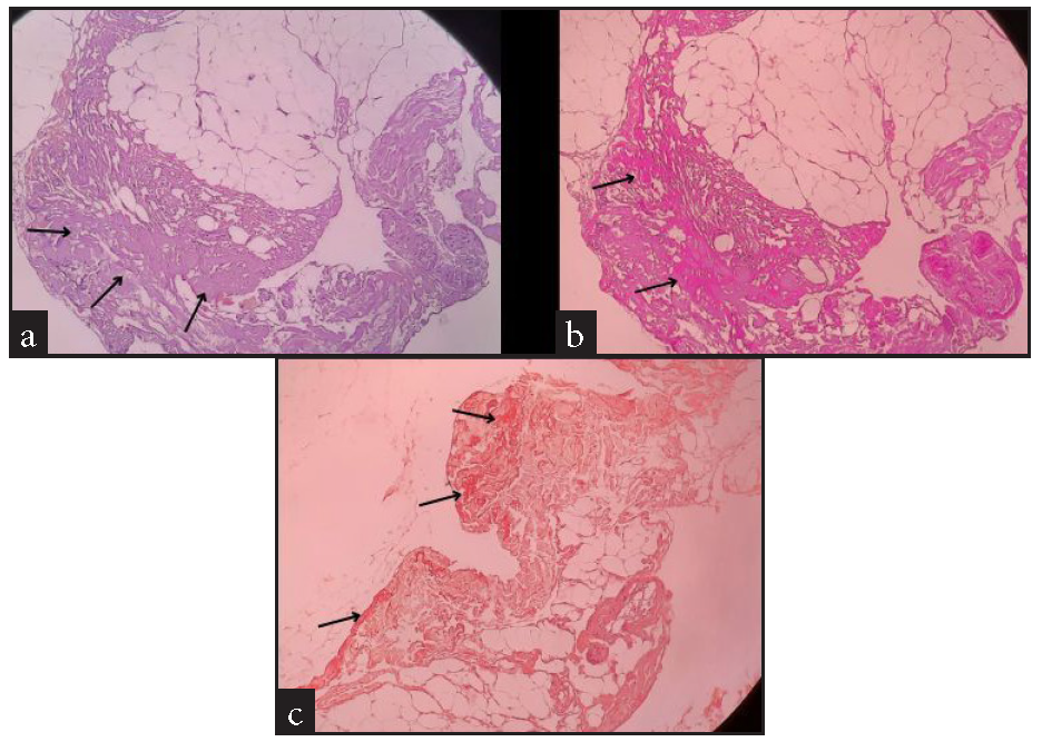 Histopathology of abdominal fat pad biopsy under different stains suggestive of amyloidosis (a) Haematoxylin and eosin shows metachromatic stain (purple) around the blood vessels & also in homogeneous acellular areas showing amyloid material (black arrow). (b) Periodic acid Schiff stain showing amyloid material (black arrow). (c) Congo red stain showing amyloid material (black arrow).