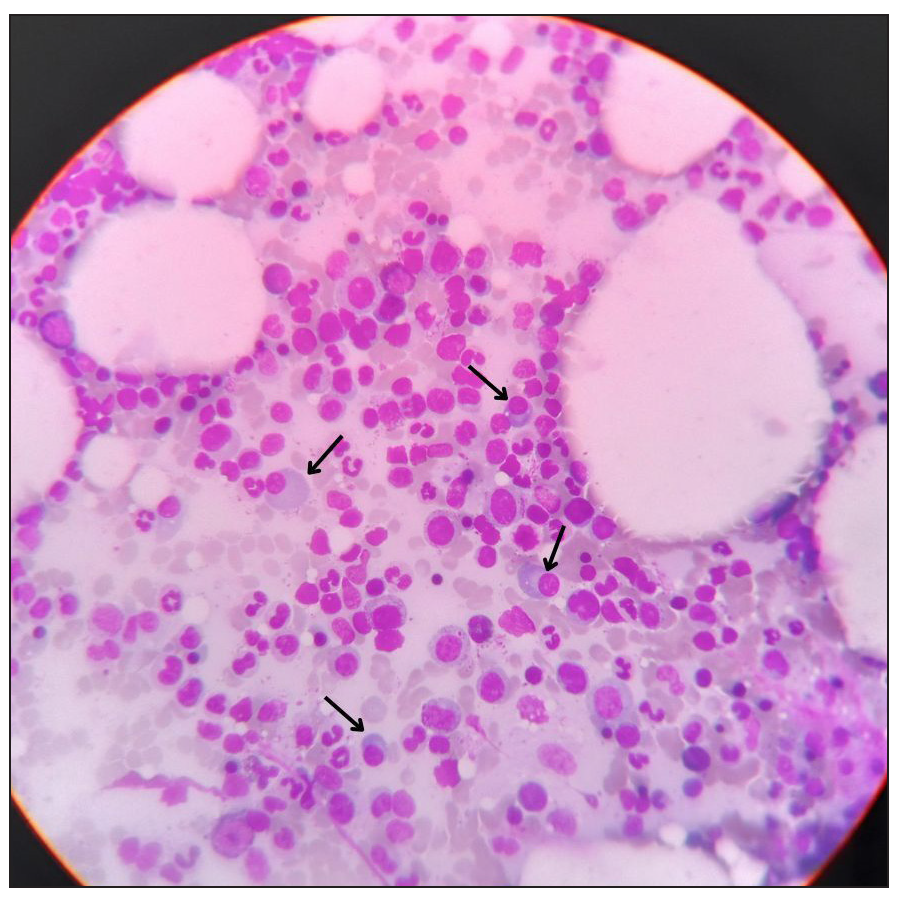 Microphotograph of bone marrow aspiration under Giemsa’s stain with both erythroid and myeloid hyperplasia displaying plasmacytosis (black arrow).