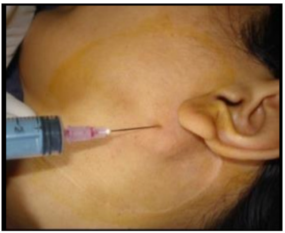 The clinical site of fine needle aspiration cytology.