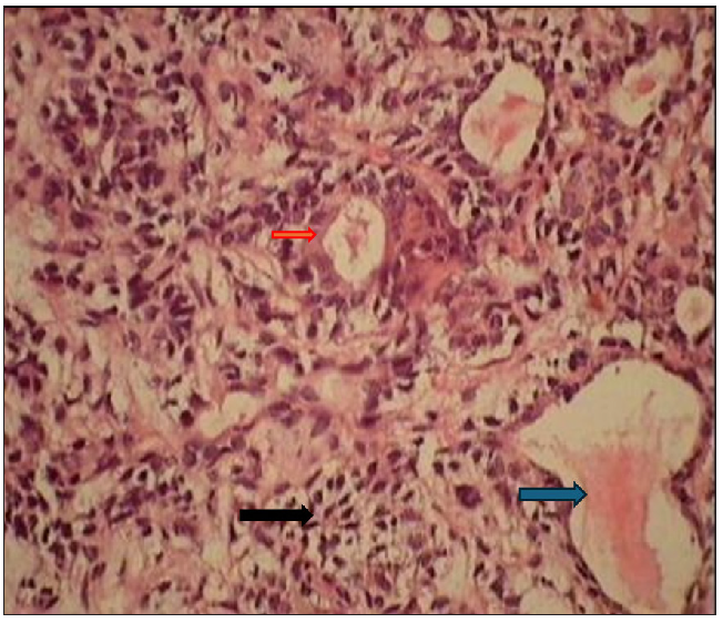 Photomicrograph shows ductal and myoepithelial cells arranged in a tubular pattern against a myxoid background (represented by an orange arrow). The ductal structure was filled with eosinophilic material (represented by a blue arrow). The myoepithelial cells are spindle to ovoid in shape (represented by a black arrow) and stained with Papanicolaou stain. 40x magnification.