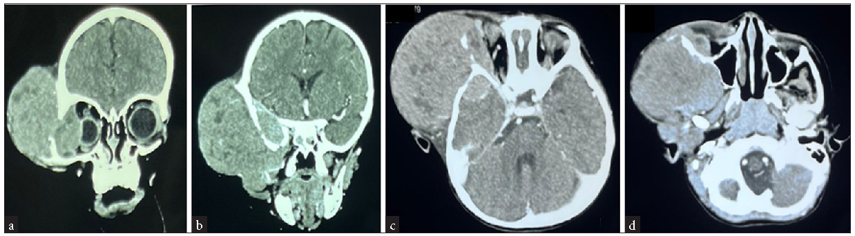 Computed tomography scan images of head, face, and neck (a) Lesion arising from right temporal and zygomatic region, (b) Intracranial extension of the lesion in the extradural plane of the right temporal and basitemporal region, (c) Orbital extension of the lesion in the extraconal region causing compression over the right globe and extraocular muscles from the lateral aspect causing proptosis of the right globe, (d) Extension of the lesion into the infratemporal fossa and encasing the coronoid process of the mandible. CT: Computed tomography.
