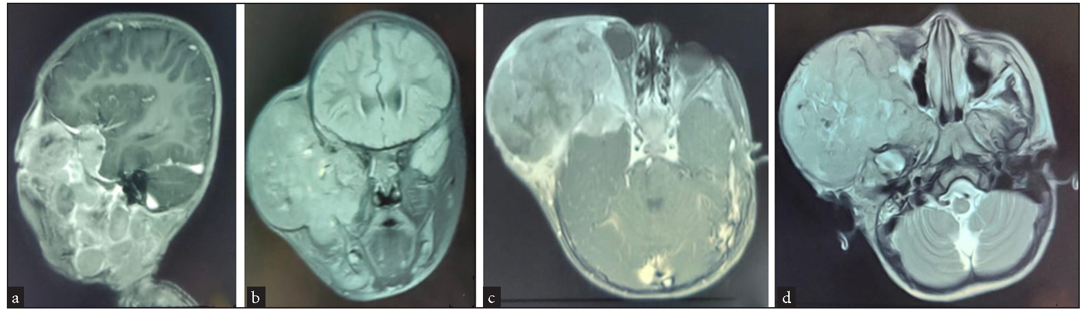 MRI images of head, face, and neck (a) Intact duramater in right temporal and basitemporal region where lesion was invading intracranially (Sagittal view), (b) Intracranial extension of the lesion in the extradural plane of the right temporal and basitemporal region (Coronal view), (c) Orbital extension of the lesion in the extraconal region causing compression over the right globe and extraocular muscles from the lateral aspect causing proptosis of the right globe, (d) Extension of the lesion into the infratemporal fossa and encasing the coronoid process of the mandible.